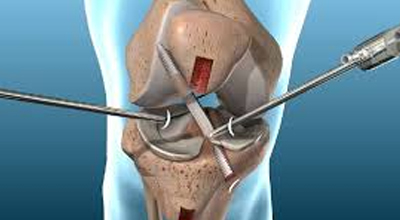 ACL & PCL Surgery