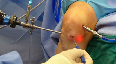 Arthroscopy