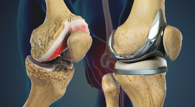 Knee Replacement